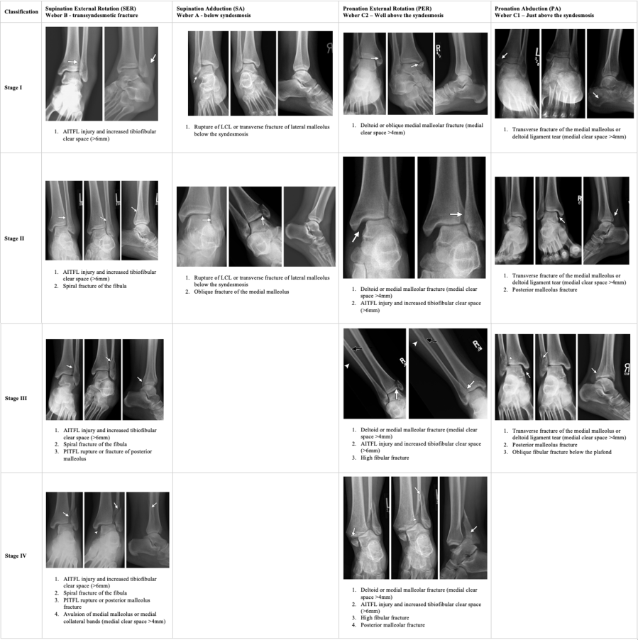 Lauge-Hansen classification — supination-adduction, supination-external rotation, pronation-abduction, pronation-external rotation fracture patterns