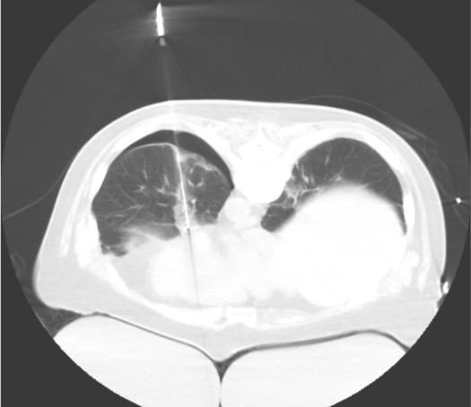 CT showing ablation probe positioned within lower lobe pulmonary mass with planned ablation zone