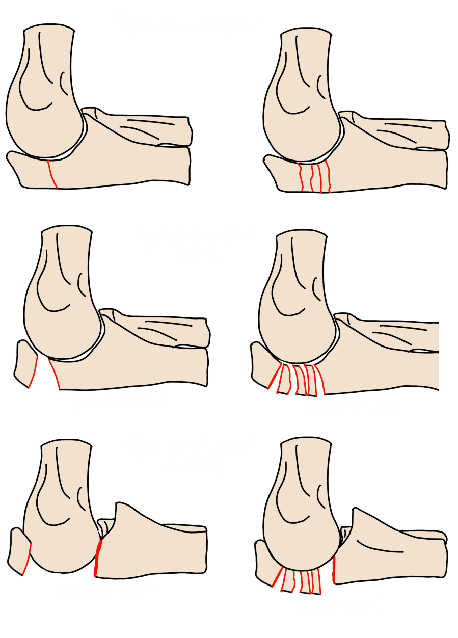 Mayo classification of olecranon fractures: I nondisplaced; II displaced stable (intact triceps); III displaced unstable