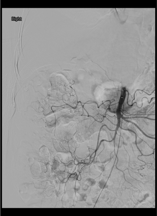 SMA angiogram demonstrating normal branching pattern including jejunal, ileal, right colic, and middle colic arteries