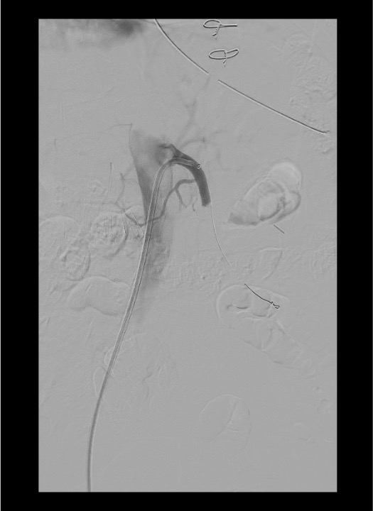 Selective SMA angiogram showing intraluminal thrombus causing acute mesenteric ischemia pre-thrombectomy