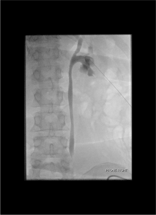 Antegrade nephrostogram confirming nephrostomy catheter position with contrast draining to bladder
