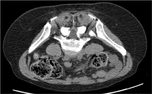 CT showing bilateral needle placement at superior cluneal nerve targets at posterior iliac crest