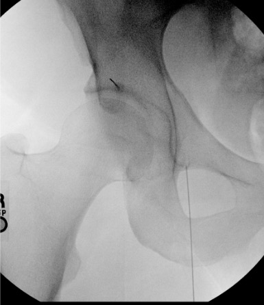 CT showing needles positioned at femoral and obturator nerve targets in groin