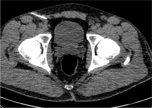 CT showing needle at genitofemoral and iliohypogastric nerve targets at inguinal region