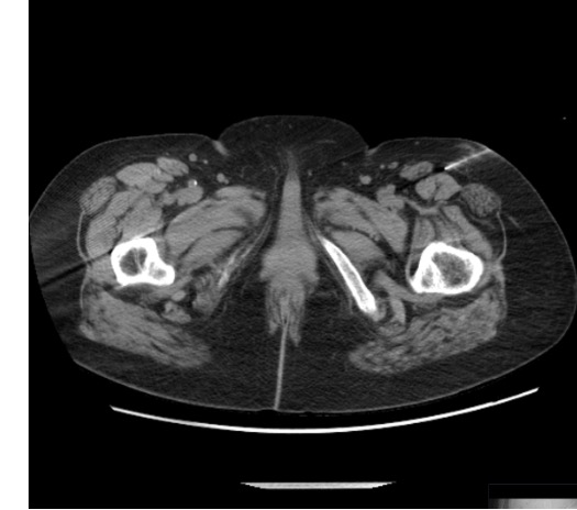 CT showing needle at lateral femoral cutaneous nerve target below inguinal ligament