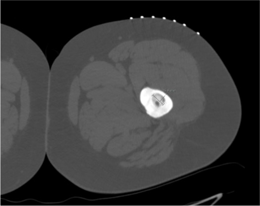 CT demonstrating classic osteoid osteoma nidus with surrounding sclerosis and cortical thickening