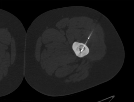 CT confirming RFA probe positioned within osteoid osteoma nidus for thermal ablation