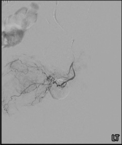 Selective angiogram demonstrating left prostatic artery with classic parenchymal blush