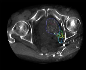 Cone-beam CT after microcatheter positioning confirming prostatic parenchymal enhancement without non-target opacification
