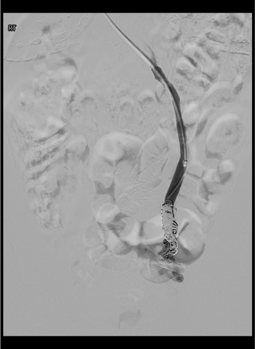 Coil pack deployed in left ovarian vein from distal varicosity plexus to ovarian vein origin