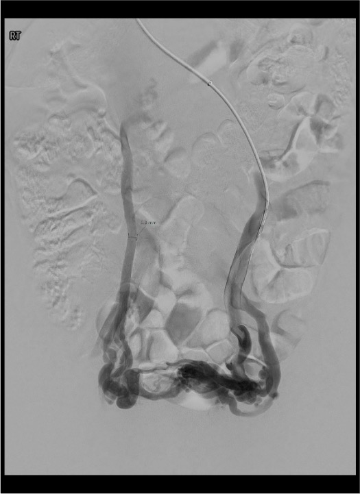 Left ovarian vein venogram demonstrating reflux and pelvic varicosities in pelvic congestion syndrome