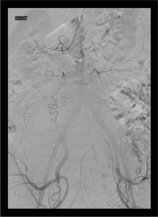 Ovarian artery providing collateral supply during PPH embolization after bilateral uterine artery occlusion