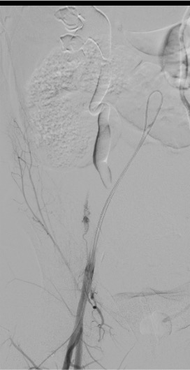 Round ligament artery opacified as collateral supply during PPH embolization