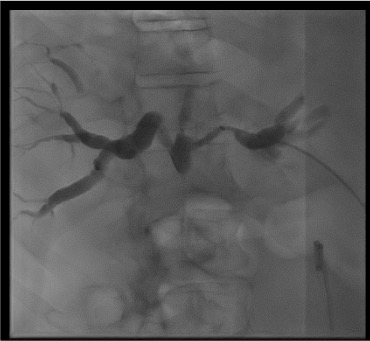 Percutaneous transhepatic cholangiogram demonstrating intrahepatic biliary dilation and obstruction level