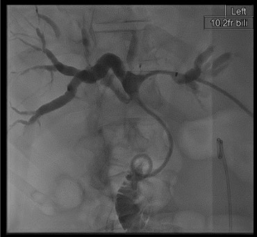 Fluoroscopic image showing internal-external biliary drainage catheter with tip in duodenum and side holes spanning obstruction