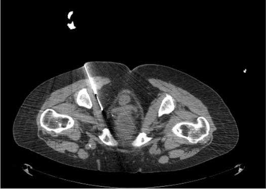 CT confirming cryoablation probe positioned at pudendal nerve in Alcock's canal