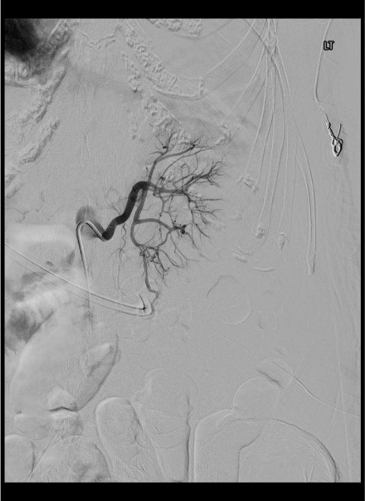 Flush aortogram demonstrating bilateral renal artery anatomy including accessory vessels