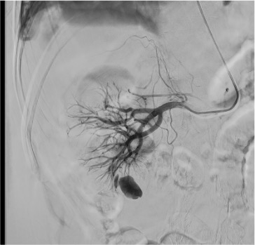 Selective renal angiogram demonstrating pseudoaneurysm with surrounding normal parenchyma