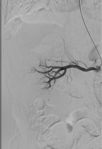 Post-embolization angiogram showing coil pack in pseudoaneurysm with no residual opacification