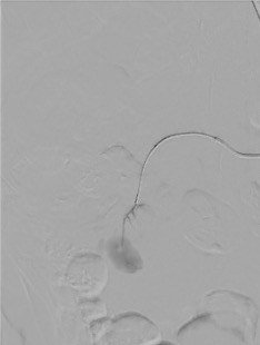 Microcatheter superselectively positioned in artery feeding renal pseudoaneurysm