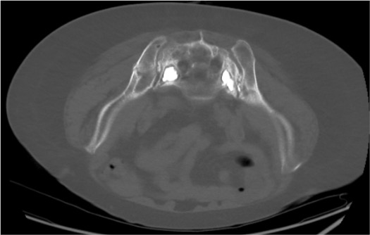 Post-sacroplasty CT showing PMMA cement distribution within bilateral sacral ala fractures
