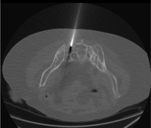 CT showing sacroplasty trocar placed along long axis of sacral ala with tip in fracture zone
