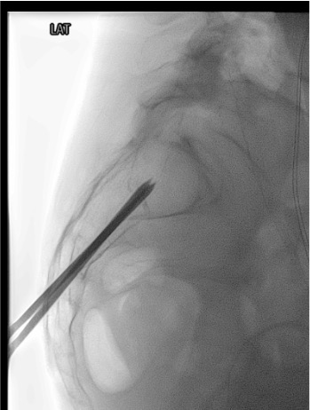 Lateral fluoroscopic view confirming sacroplasty trocar depth and anterior sacral cortex proximity
