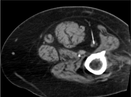 CT showing cryoablation probe positioned adjacent to sciatic nerve at piriformis level for phantom limb pain