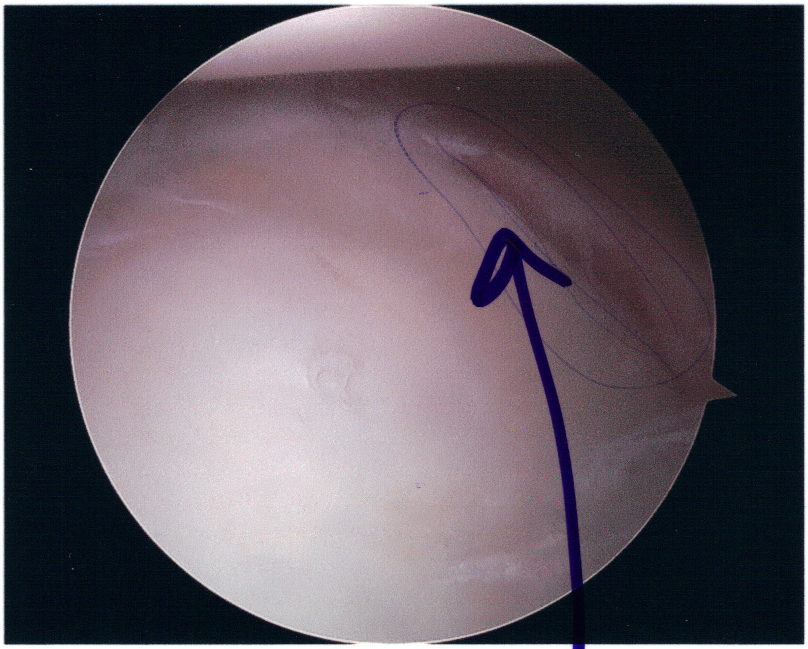 Bankart lesion — anteroinferior labral tear at 3–6 o'clock position on arthroscopy