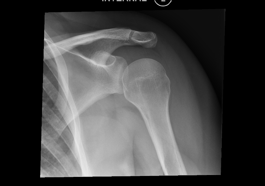 Hill-Sachs lesion — internal rotation AP radiograph best demonstrates the posterolateral humeral head impaction defect