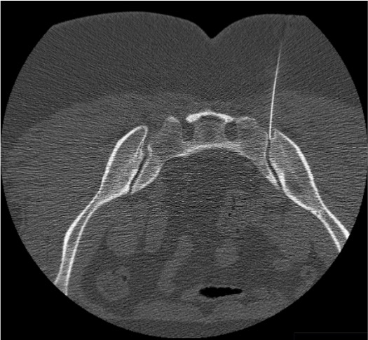CT showing needle at the posterior inferior SI joint margin for intra-articular injection