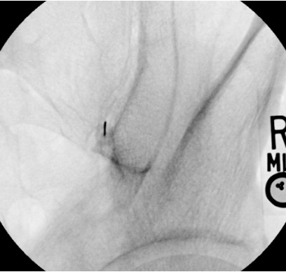 Fluoroscopic arthrogram confirming intra-articular contrast spread within the SI joint