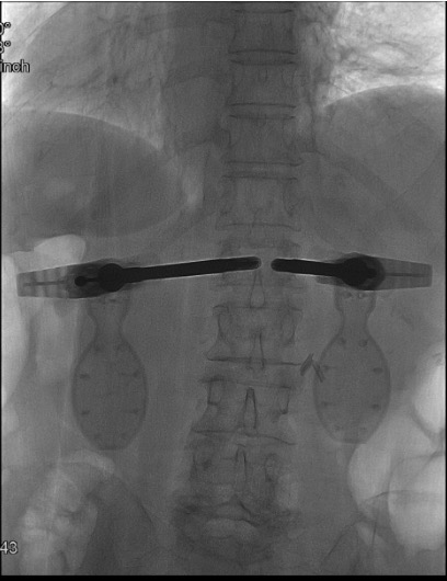 Fluoroscopy showing bilateral SpineJack expanders deployed with device deployment tool