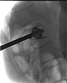 Post-procedure fluoroscopy showing SpineJack devices with surrounding PMMA cement and restored vertebral height