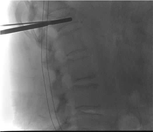 Lateral fluoroscopy showing reamer advancing to create cavity for SpineJack device placement