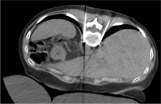 CT showing ablation probe positioned at T11-T12 paravertebral space for splanchnic nerve ablation