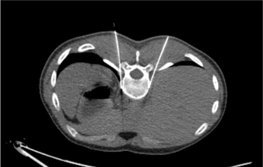 CT showing needle positioned at T11-T12 paravertebral space for splanchnic nerve block