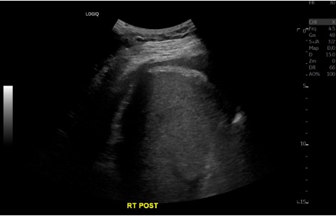 Post-procedure ultrasound showing reduced right pleural effusion