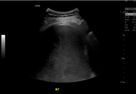 Pre-procedure ultrasound showing right pleural effusion