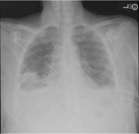Post-procedure CXR showing interval improvement after thoracentesis