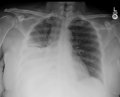 Pre-procedure CXR showing large left pleural effusion