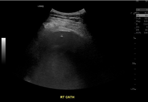 Ultrasound during thoracentesis showing catheter in right pleural effusion