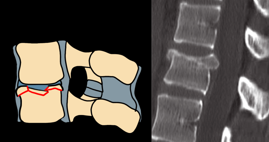 AO Type A3/A4 burst fracture — diagram and CT showing posterior wall retropulsion and vertebral body comminution