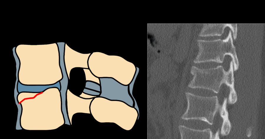 AO Type A1 wedge compression fracture — diagram and CT showing single endplate fracture with anterior wedging