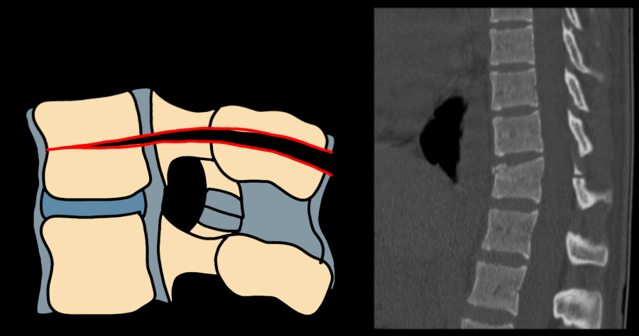AO Type B1/B2 flexion-distraction Chance fracture — diagram and CT showing posterior tension band disruption with anterior distraction
