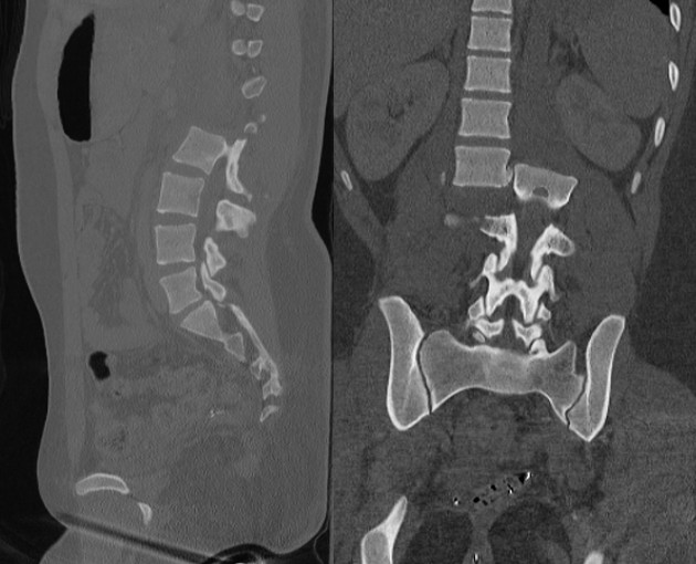 AO Type C fracture-dislocation — CT sagittal and coronal showing complete translational displacement of the spinal column