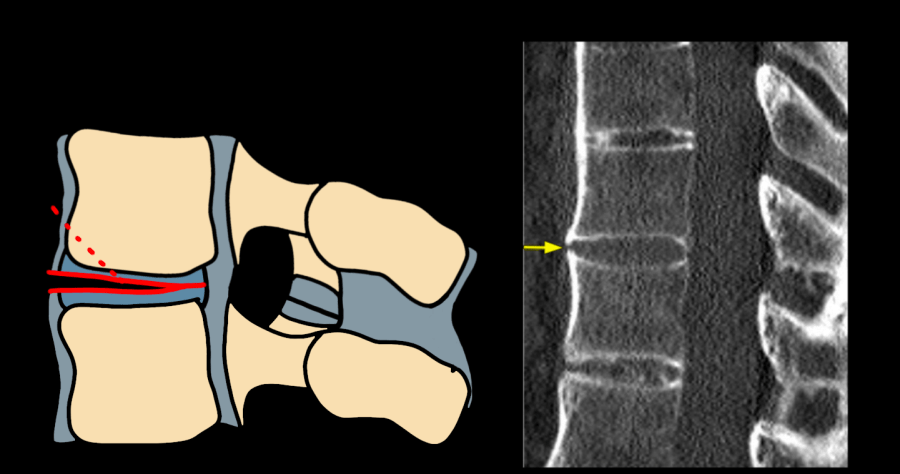 AO Type B3 hyperextension injury — diagram and CT showing anterior tension band disruption through disc with anterior column distraction