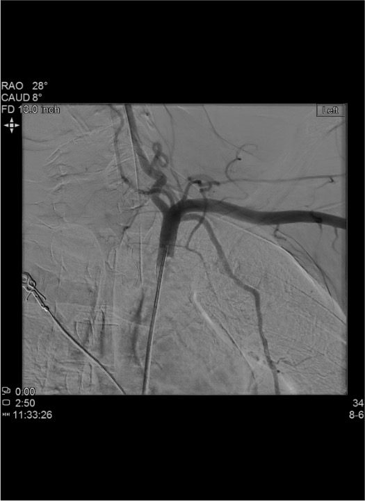 Internal mammary artery providing collateral supply in upper extremity vascular trauma with proximal subclavian or axillary occlusion