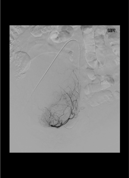 Superselective microcatheter position in left uterine artery showing fibroid supply